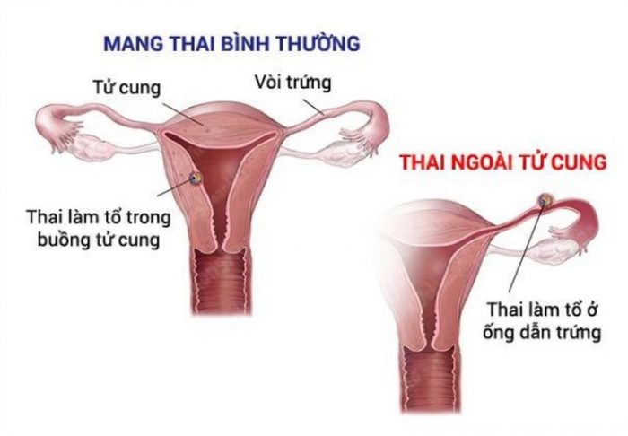 Thai ngoài tử cung thì niêm mạc có dày không