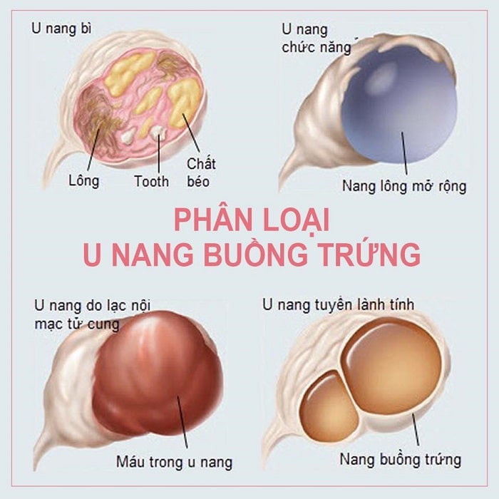 u nang bì buồng trứng là 1 loại u nang buồng trứng