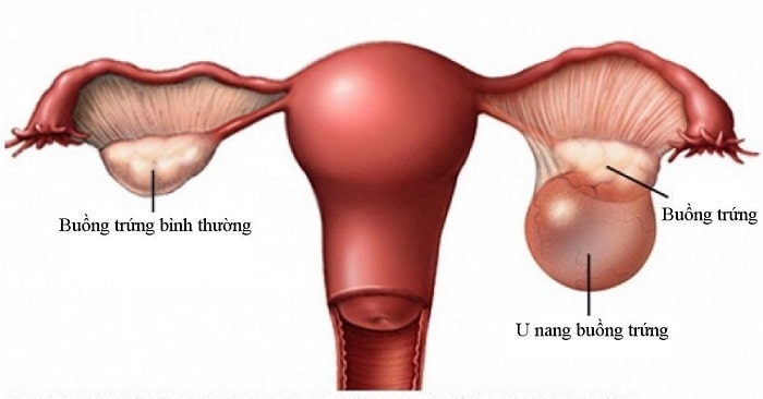 U nang buồng trứng khi đang mang thai