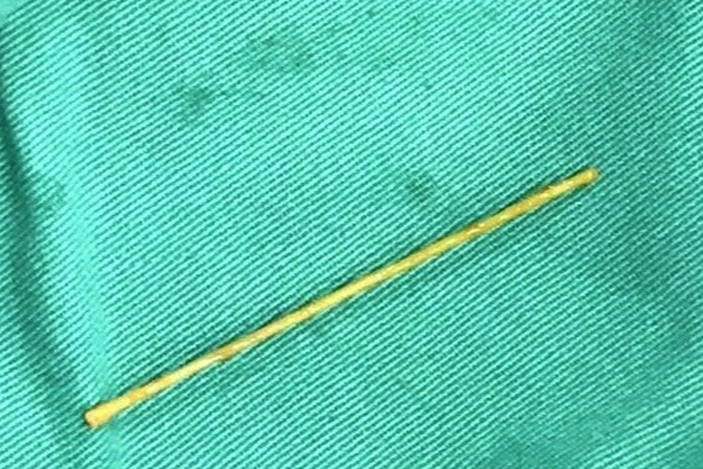 Nuốt tăm tre dài 5cm, người đàn ông bị thủng tá tràng - 1 Nuốt tăm tre dài 5cm, người đàn ông bị thủng tá tràng - 1