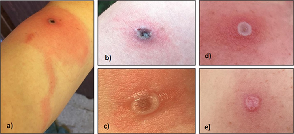 Virus đậu mùa Alaska mới xuất hiện nguy hiểm như thế nào? - 2