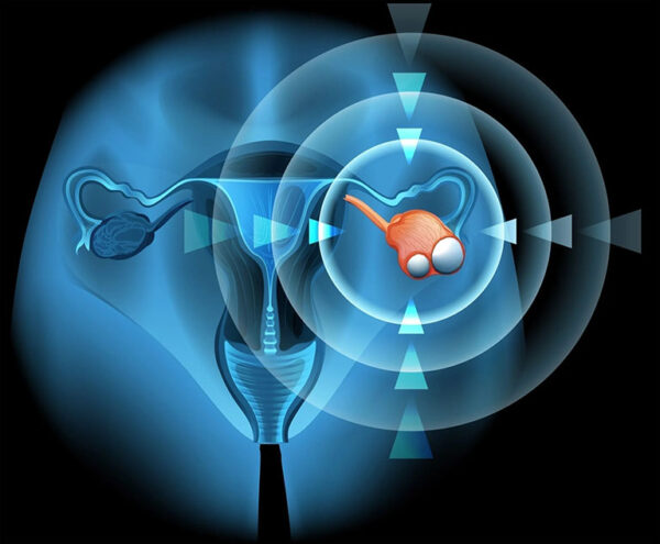 U nang buồng là khối u phát triển bất thường bên trên hoặc bên trong buồng trứng