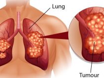 Phát hiện ở thời kỳ sớm, ung thư phổi vẫn có thể tái phát
