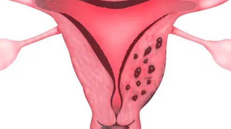 Lạc nội mạc tử cung là tình trạng các mô, tế bào nội mạc tử cung xuất hiện ở ngoài tử cung