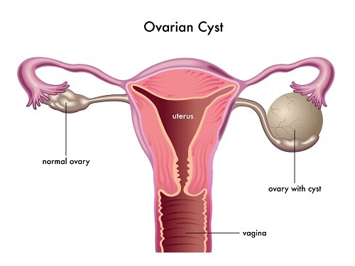 Nang buồng trứng là một trong những tình trạng thường gặp ở các chị em. 