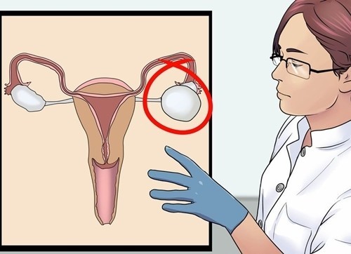 Nang buồng trứng có thể gây vỡ nang, xoắn nang, gây biến chứng nguy hiểm.