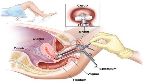 Nội soi buồng tử cung là phương pháp thực hiện nhằm mục đích là quan sát bên trong buồng tử cung và xử trí các bất thường (nếu có)